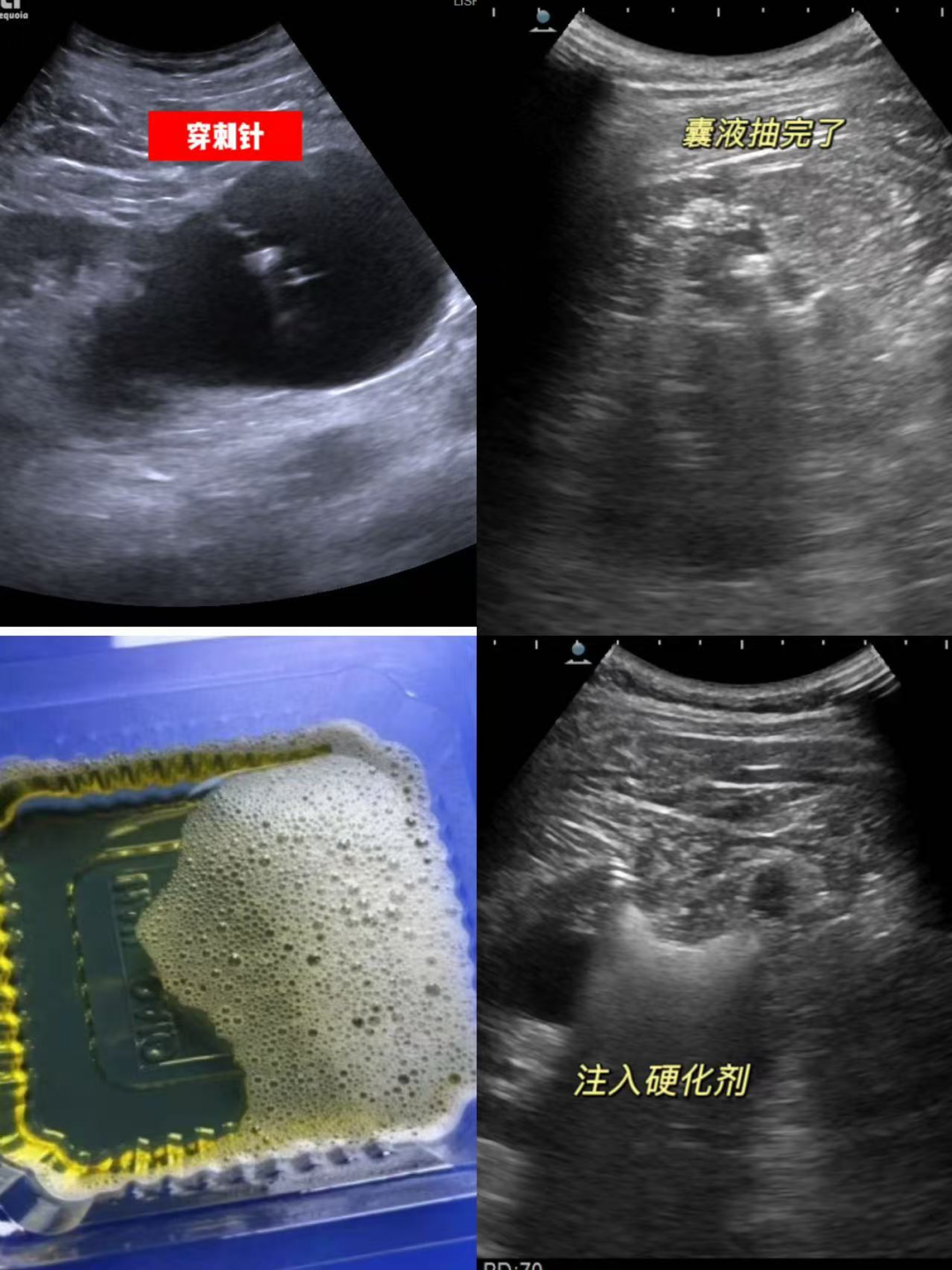穿刺2.png